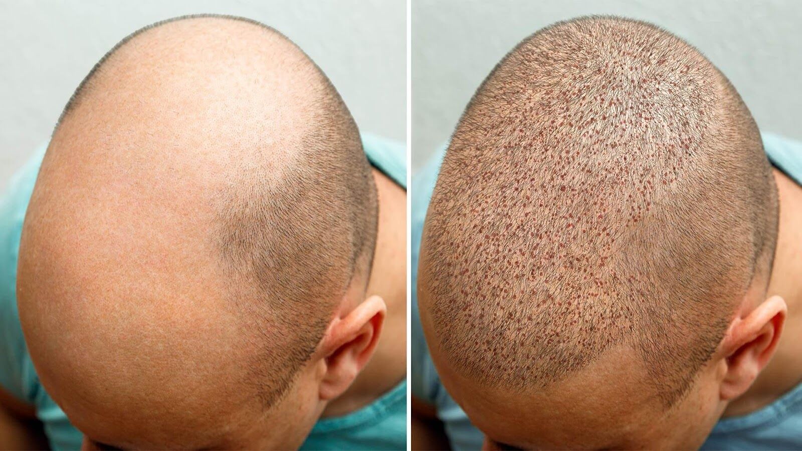Why Get a Hair Transplant & How to Choose a Clinic in Fort Lauderdale